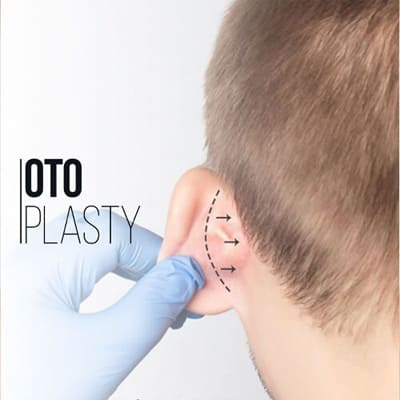 Otoplasty